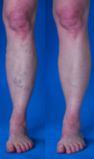 Combination Spider and Varicose Veins