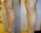 Varicose Veins