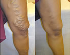 Varicose Veins