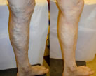 Varicose Veins