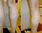 Varicose Veins