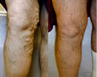 Varicose Veins