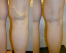 Varicose Veins