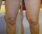 Varicose Veins