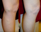 Varicose Veins