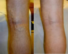 Varicose Veins