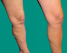 Varicose Veins