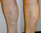 Varicose Veins