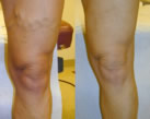 Varicose Veins