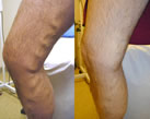 Varicose Veins