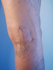 Spider Vein Example