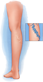 Varicose Vein Illustration